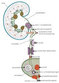 Dette kan oppstå hvis kreften sprer seg til en indre hoftemuskulatur kalt iliopsoas og. Hydronefrose Store Medisinske Leksikon