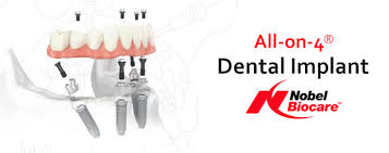 2,971 free dental implants products are offered for sale by suppliers on alibaba.com, of which other dental equipments accounts for 19%, dental consumables accounts for 6%, and oral therapy equipments & accessories accounts for 2%. Affordable All On 4 Dental Implants In India By Top Dental Professionals