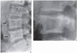 You can find the other videos in the links down below. Paget Disease Radiology Key