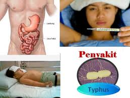 Hasil gambar untuk tifus pada anak