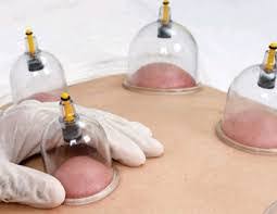 Cupping and massage | Health Avenue Cupping Clinic Hijama