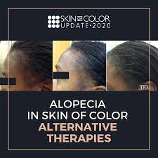 Alopecia In Skin Of Color Alternative Therapies Next Steps In Dermatology