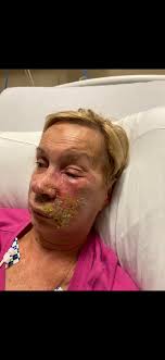 Hey everyone do I need to see a doctor for shingles or a pharmacist can  help?