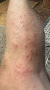 Image result for ant bite