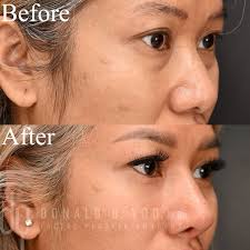 Donald B. Yoo MD, FACS (@asianrhinoplasty) • Threads, Say more