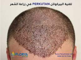 ماهي تقنية البيركوتان perkutan في زراعة الشعر تقنية البيركوتان perkutan في زراعة الشعر من أكثر التقنيات تطورا بمجال زراعة ال knitted hats knitting 10 things