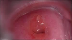 Image result for Colposcopy