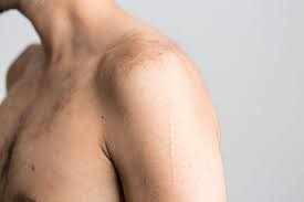 Shoulder Wikipedia If your hand or arm gets numb, the cause could range from sleeping in one position for too long to a medical condition like carpal tunnel syndrome or diabetes. shoulder wikipedia