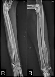Image result for Osteomyelitis XRay