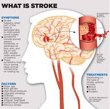 Can high cholesterol cause a stroke. Poor Thinking Skills Linked To Higher Chances Of Heart Attack Stroke Steemit