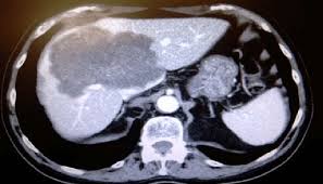Colon cancer is currently the fourth most common cancer diagnosed in the united states. Huge Liver Metastasis In A 64 Year Old Patient With Colon Cancer First Download Scientific Diagram