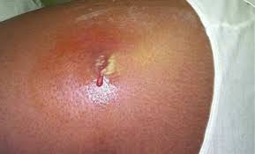 Mrsa is a staph germ (bacteria) that does not get better with the type of antibiotics that usually cure staph infections. Bug Jumping Mrsa Isn T Just A Hospital Infection Anymore Jems