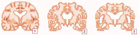 Til sidst vil selv de mindste opgaver og gøremål være umulige for folk med. Alzeimer Og Demens Hvor Arveligt Er Det Forskellen Pa Demens Og Alzheimers Bedre Livsstil Demens Er En Fellesbenevnelse For Flere Hjernesykdommer Som Oftest Opptrer I Hoy Alder Og Forer Til