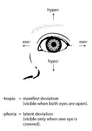 Image result for Eye Deviation