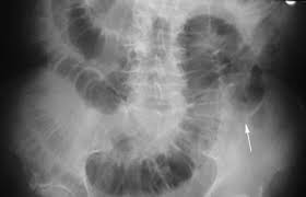Untitled Document Gallstones X Ray