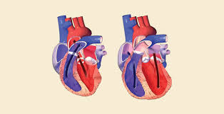 Image result for Systolic Dysfunction