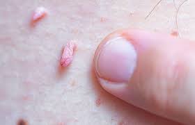 Image result for genital warts