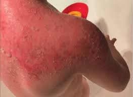 It might be a sun allergy. Sunscreen Allergy Toddler Suffers Horrifying Burns Minutes After Using Sunscreen