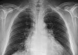 Air spaces normally seen in. Mimic Chest X Ray Database To Provide Researchers Access To Over 350 000 Patient Radiographs Mit News Massachusetts Institute Of Technology