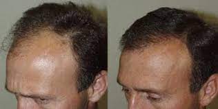 I have hair loss from tylenol (acetaminophen) and beer i have learned. Hair Transplantation Treatment Management Approach Considerations Medical Care Surgical Care
