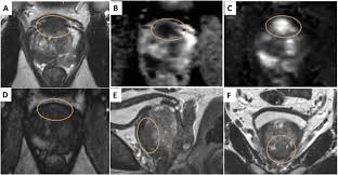 This trial focused on the accuracy of mri for staging prostate cancer in men with clinically localized disease and who had radical prostatectomy. Multiparametric Magnetic Resonance Imaging For The Detection Of Clinically Significant Prostate Cancer What Urologists Need To Know Part 2 Interpretation European Urology