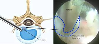 Maybe you would like to learn more about one of these? Endoscopic Disc Decompression Treatment For Slipped Disc