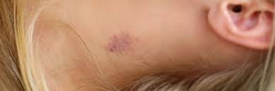 Apply a good moisturizer on your skin to cancel the drying effect of rubbing alcohol. 15 Ways How To Get Rid Of A Hickey Fast Healthgardeners