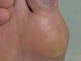 Poor circulation can make these injuries slow to heal. Blue Toe Syndrome Dermnet Nz