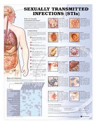 Sexually Transmitted Infections Stis Chart Poster Laminated