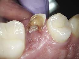 Losing baby teeth is a rite of passage for. It S Like Pulling Teeth Cornelia Dental