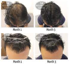 Make sure you're including a variety of vegetables, fruits, whole grains, unsaturated fats, and lean proteins in your diet, and limit your. General Hair Thinning Regrow Hair