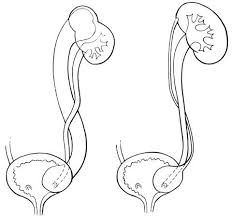 Understanding Duplication Anomalies of the Kidney