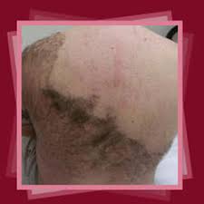 Destination treatments have begun to. Laser Hair Removal Diode Laser With Shr Hair Removal Treatment Service Service Provider From New Delhi