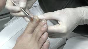 Und dabei gebe ich euch tipps, wie man die vielen vorteile dieses systems genießen kann und die (wenigen) nachteile so. Nagelkorrekturspange Youtube