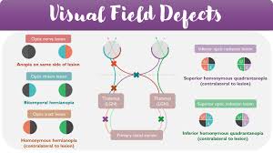 Image result for Visual Field Deficit