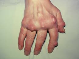 Histological study confirmed the diagnosis. Gout Signs Symptoms And Complications