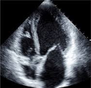 Image result for Cardiomyopathy