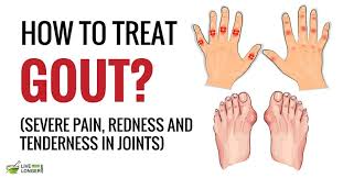 Pin On Arthritis Gout Treatments