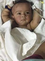 Bangladesh Performs 'First' Conjoined Twin Surgery