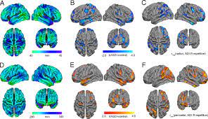 Autistic disorder (sometimes called autism or classical asd) is the most common condition in a group of developmental disorders known as the autism spectrum disorders (asds).autistic children have difficulties with social interaction, display problems with verbal and nonverbal communication, and exhibit repetitive behaviors or narrow, obsessive interests. Intrinsic Gray Matter Connectivity Of The Brain In Adults With Autism Spectrum Disorder Pnas