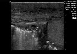 Honestly, you don't wanna know. Fournier Gangrene On Bedside Ultrasound The Em Pulse