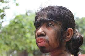 Werewolf syndrome is generally considered a genetic condition, but in these recent cases, it was seemingly caused by minoxidil, a medicine often used to treat male pattern baldness. Inkl Sixteen Children Develop Werewolf Syndrome From Taking Contaminated Medicine On Spain S Costa Del Sol The New Zealand Herald