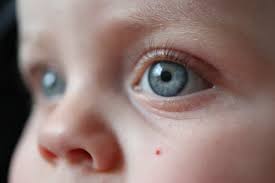 They are the most common vascular proliferations in the skin. Spot Under Eye Babycentre