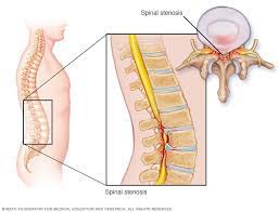 Download this topic as a pdf. Spinal Stenosis Symptoms And Causes Mayo Clinic