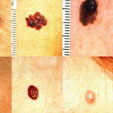 Having a stage 3 melanoma means a greater chance that the cancer will come back later somewhere else in the body (stage 4melanoma ). Skin Cancer Melanoma Image Data Kaggle