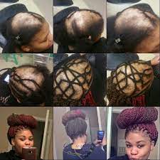 For Those Suffering From Alopecia It Doesn T Have To Be A Sufferable Sentence Of Life Without Hair Natural Hair Styles Hair Styles Alopecia Hairstyles