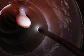 Binderow continues, ct is very good for solid organ disease — liver, spleen, kidneys. 8 Common Myths About Colon Cancer Cancer Ut Southwestern Medical Center