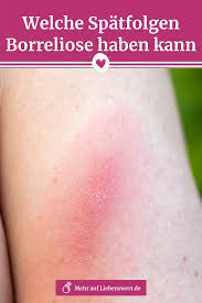 Borreliose Symptome Erkennen Spatfolgen Vermeiden In 2020 Borreliose Spatfolgen Gesundheit Naturliche Gesundheit
