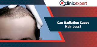 However, for about 60%, hair loss persists for 6 or more months after completion of radiotherapy, the authors note. Can Radiation Cause Hair Loss Clinicexpert International Hair Transplant Plastic Surgery
