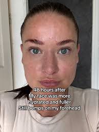 Hyaluronic Acid Serum Result